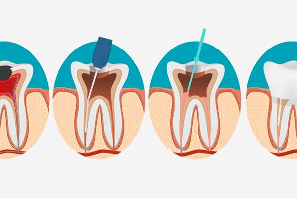 Figura de una endodoncia