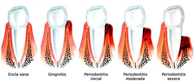 Imagen de enfermedades periodontales