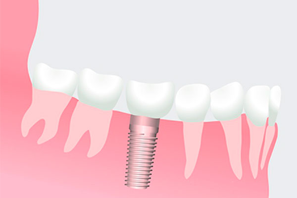 Figura de implantes dentales